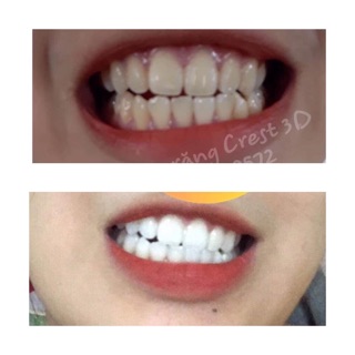 MIẾNG DÁN TRẮNG RĂNG CREST 3D WHITE ✨ LOẠI Professional