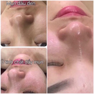 Ủ MỤN OHIO HÀN QUỐC