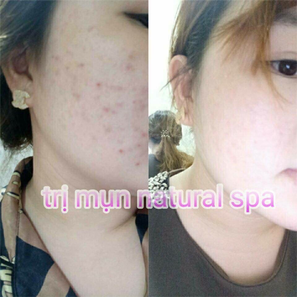 Kem Ngăn Ngừa Mụn Acne Dr Cell