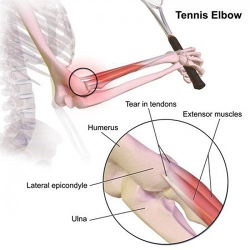 [Reefit Sport] Đai quấn bó cơ khuỷu tay SP Support Tennis Elbow