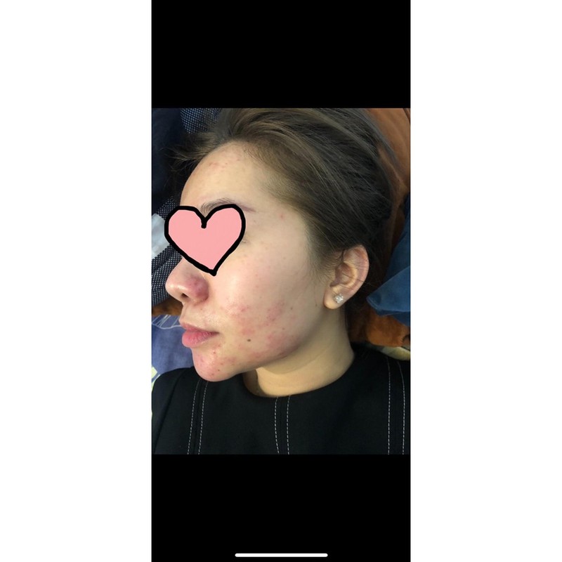 Serum Diếp Cá handmade - giảm mụn, thâm, dưỡng da căng bóng | BigBuy360 - bigbuy360.vn