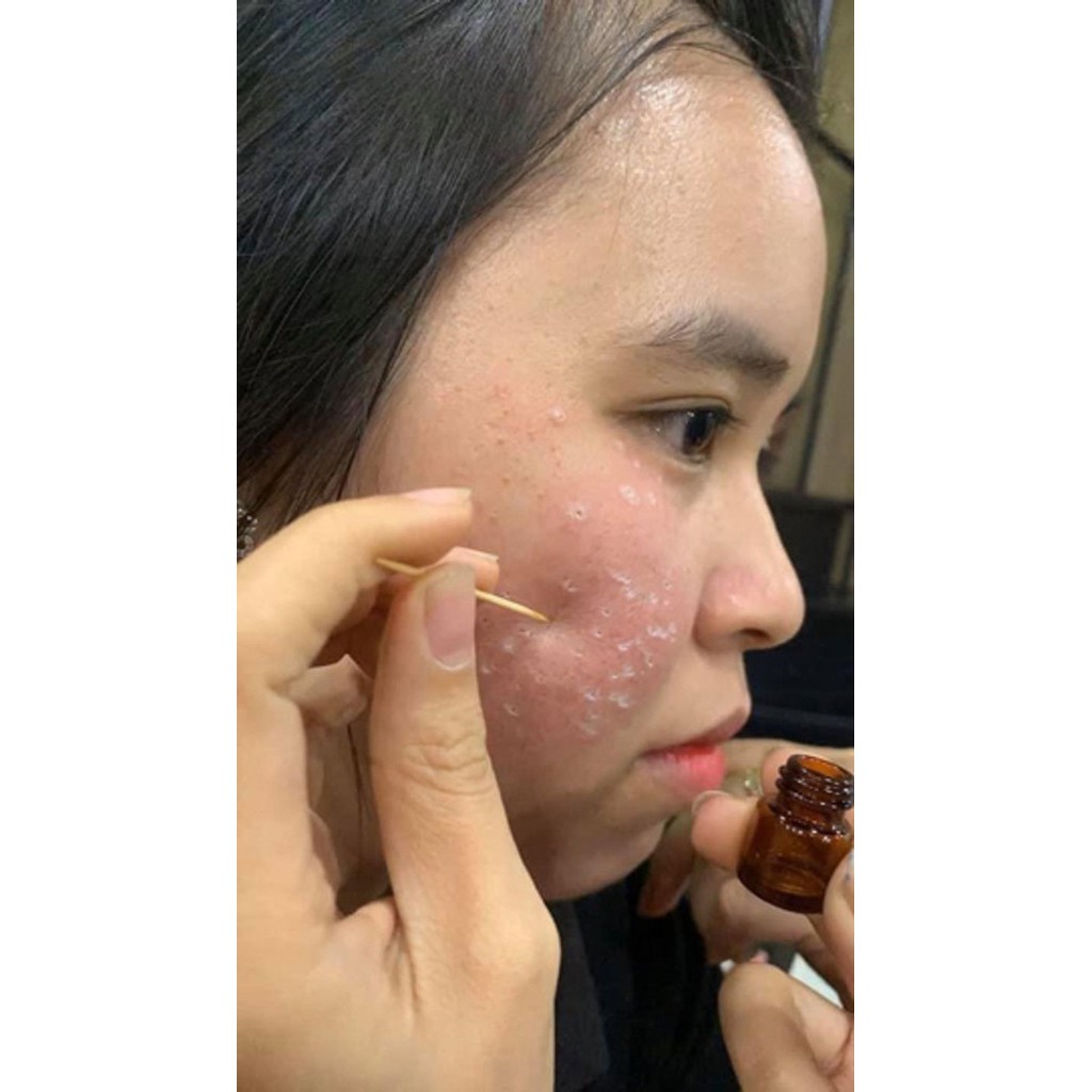 Dung Dịch Chấm Nám, Tàn Nhang, Làm Đầy Sẹo Rỗ, Xóa Nốt Ruồi Handmade | BigBuy360 - bigbuy360.vn