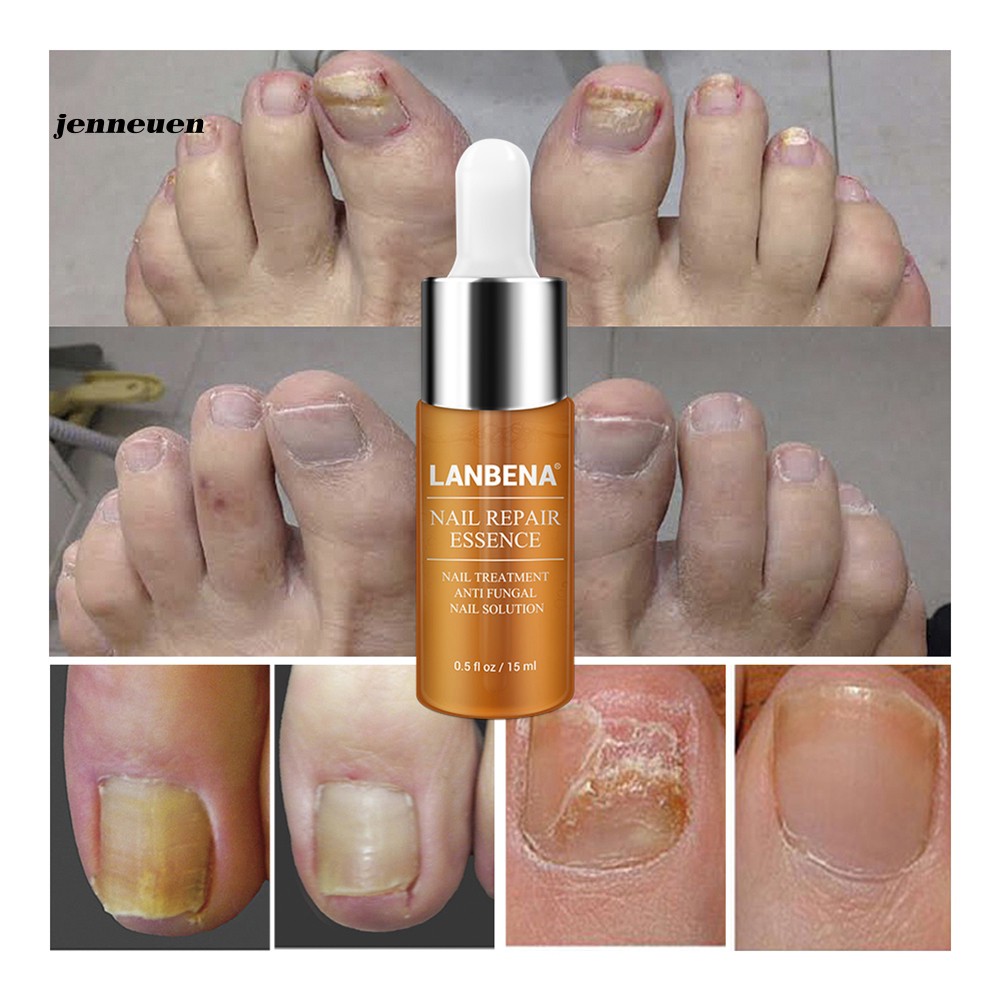 [Hàng mới về] Tinh chất phục hồi móng tay chống nấm 15ml | BigBuy360 - bigbuy360.vn