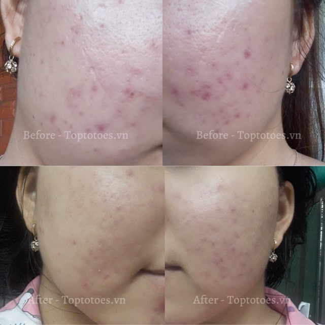 Serum Teana Super Peptides ASAP dưỡng trắng, mờ thâm, cải thiện kết cấu da