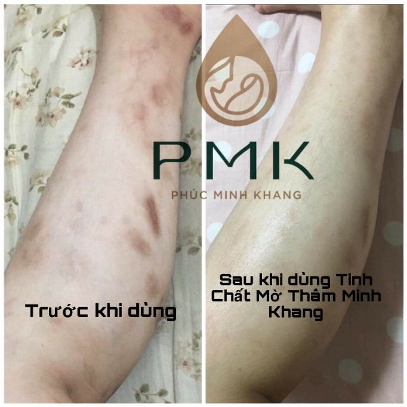 Tinh chất Xóa mờ thâm Minh Khang- Xoá thâm Sẹo,thâm mắt, thâm môi,thâm nách,thâm mụn,thâm gãi ngứa - Chính Hãng