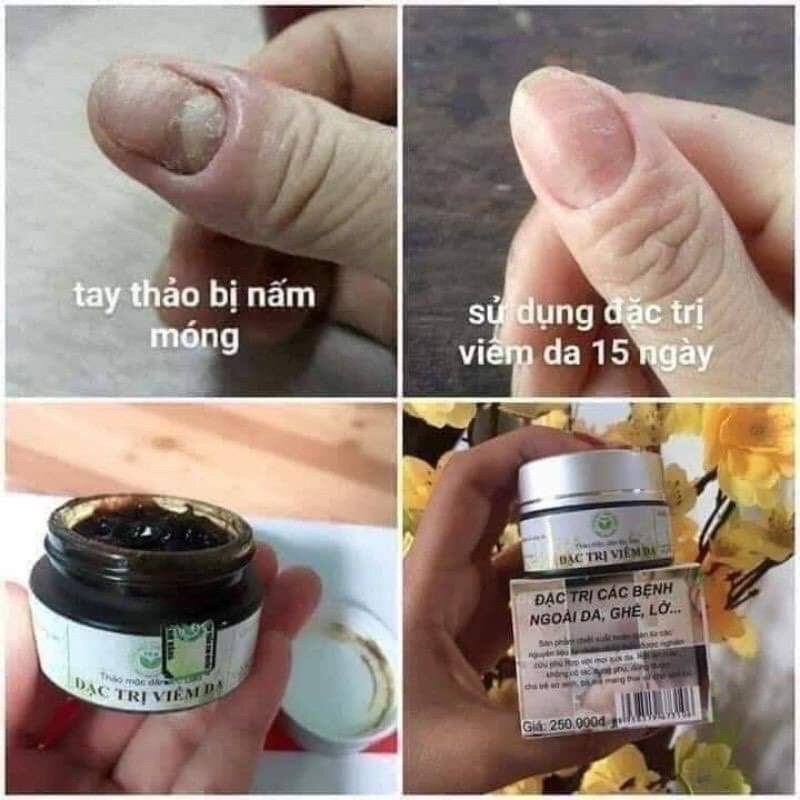 BÔI DA ĐEN TKH