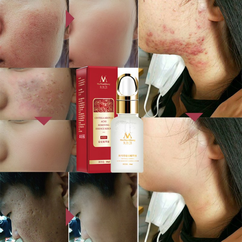 Centella Asiatica Essence Hydrating Control Oil Face Skin Care | BigBuy360 - bigbuy360.vn