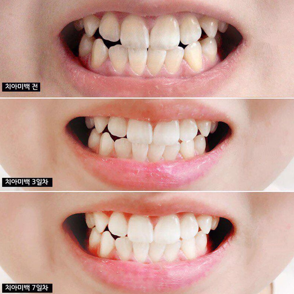 Kem đánh răng Median Dental IQ 93% White ( trắng) làm trắng răng