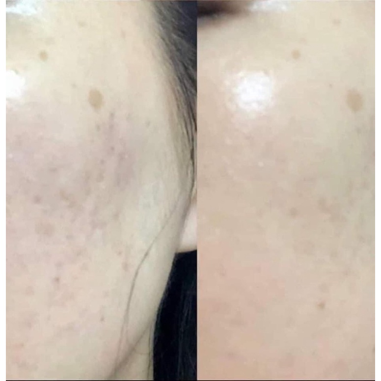 Serum trắng da, mờ thâm nám tàn nhang Neoretin Discrom Control Serum Booster Fluid 15ml