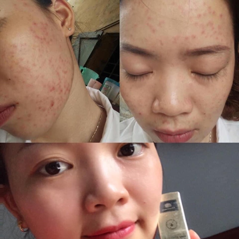 Serum mụn không sưng cốt rượu sake Sake Acnes Liquid Magic Skin