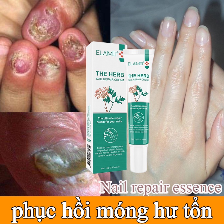 Kem Dưỡng Móng Phục Hồi Móng Nấm 15g- Móng Hư Tổn Móng kháng khuẩn chân loại nấm móng gãy móng chống các bệnh nấm móng nhanh dùng nam và nữ Móng kháng khuẩn