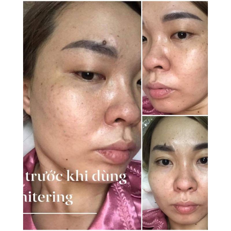 SERUM WHITENING BYUNHWAROUM TRẮNG DA- ĐÁNH BAY NÁM- TÀN NHANG HIỆU QUẢ