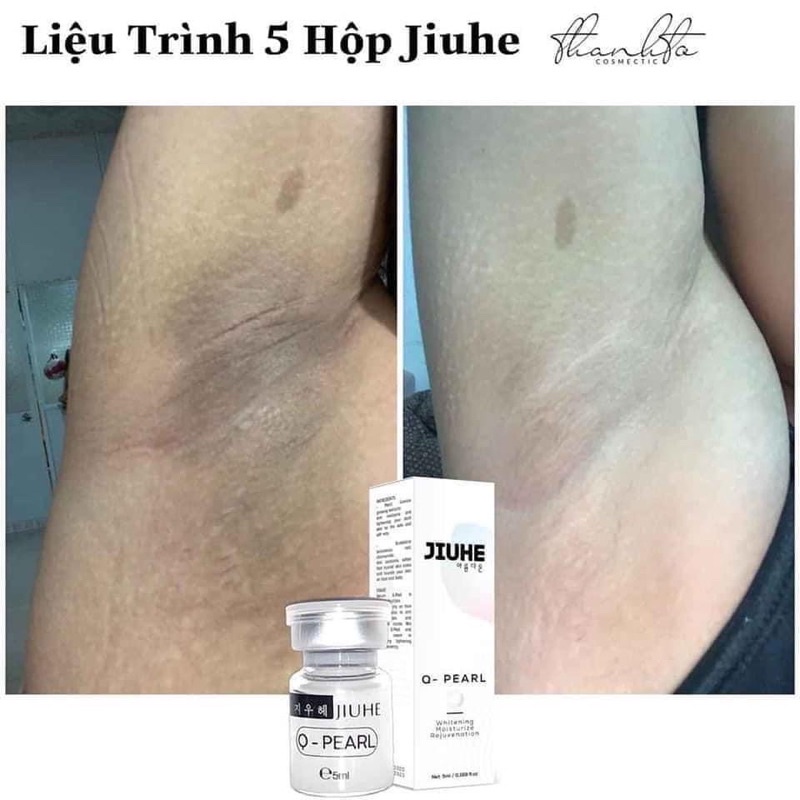 [HÀNG CHÍNH HÃNG] Serum Jiuhe xoá mờ thâm mụn, thâm các vùng cánh, mông, sẹo, nám - Loại bỏ những vết thâm lâu năm