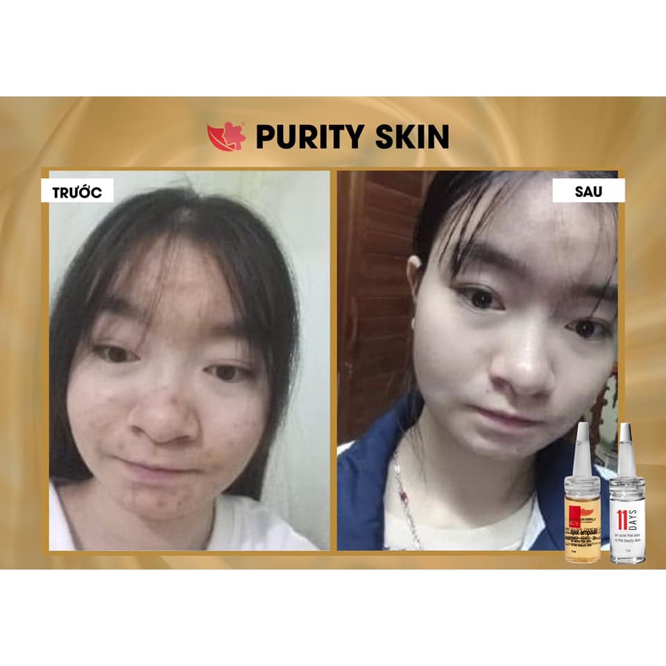 Bộ Serum mụn Linh Hương Purity Skin 11ml đánh bay mụn hết thâm làm mịn da hiệu quả trong 11 ngày