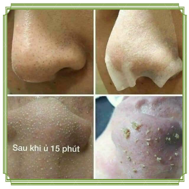 (FULL CHAI) DUNG DỊCH Ủ MỤN MEDIPEEL CHUYÊN DÙNG SPA | BigBuy360 - bigbuy360.vn