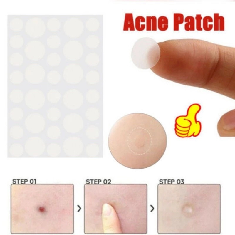 Miếng dán mụn 36 miếng giúp làm xẹp mụn nhanh, chống viêm nhiễm
