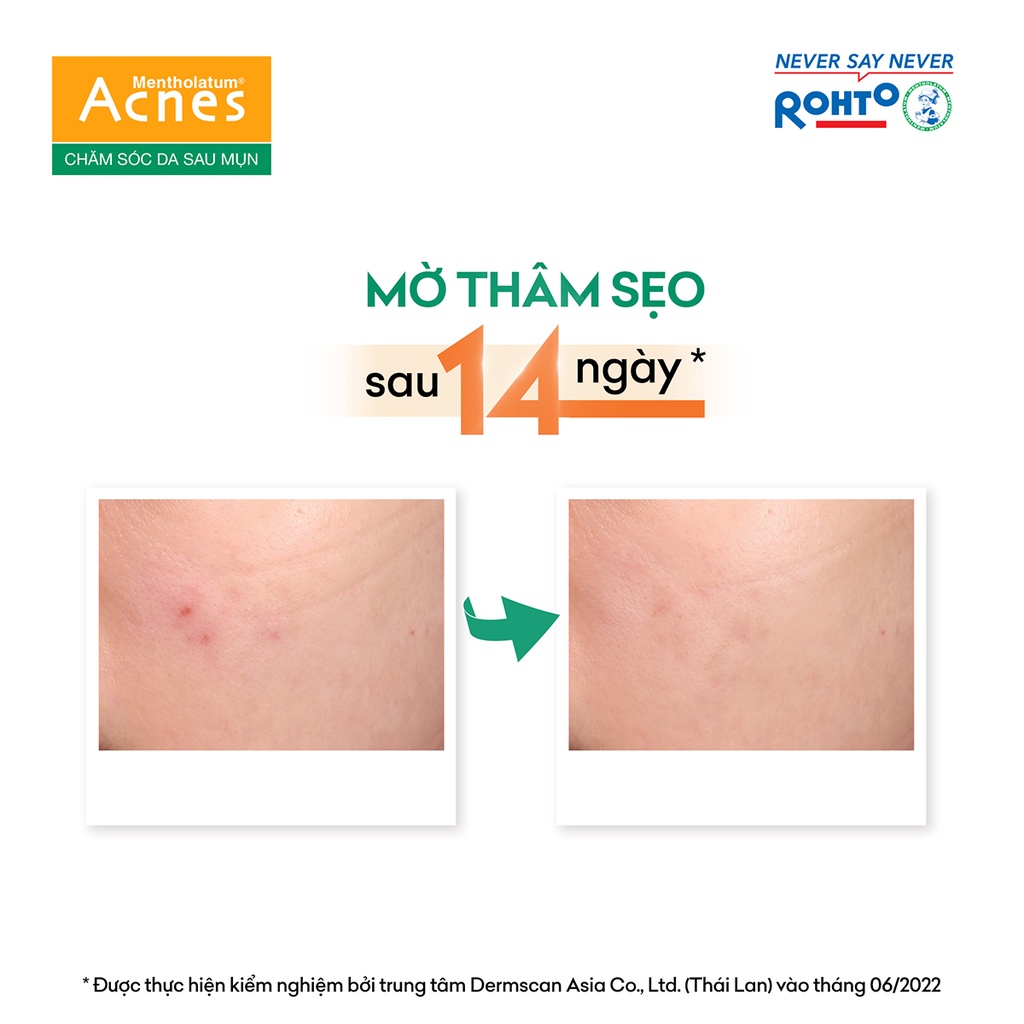 Kem mờ sẹo và thâm dạng gel Acnes Scar Care 12g