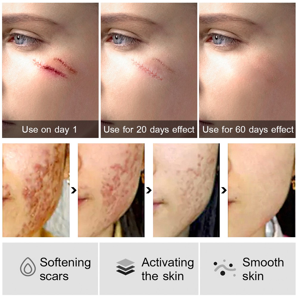 Serum Xóa Sẹo Mụn VIBRANT GLAMOUR Giảm Đốm Loại Bỏ Vết Rạn/Nếp Nhăn Làm Trắng Thu Nhỏ Lỗ Chân Lông 15ml | BigBuy360 - bigbuy360.vn