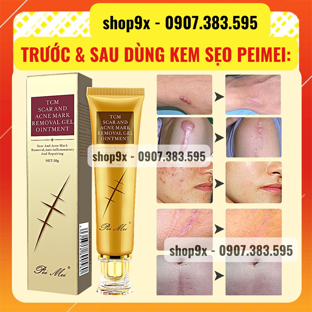 Kem Mờ Sẹo Mờ Thâm Peimei - Kem Giảm Sẹo Và Rạn Da - Chống Sẹo Lồi Sẹo Lõm Hiệu Quả Sau 1 Tuần 30gr // Shop9X