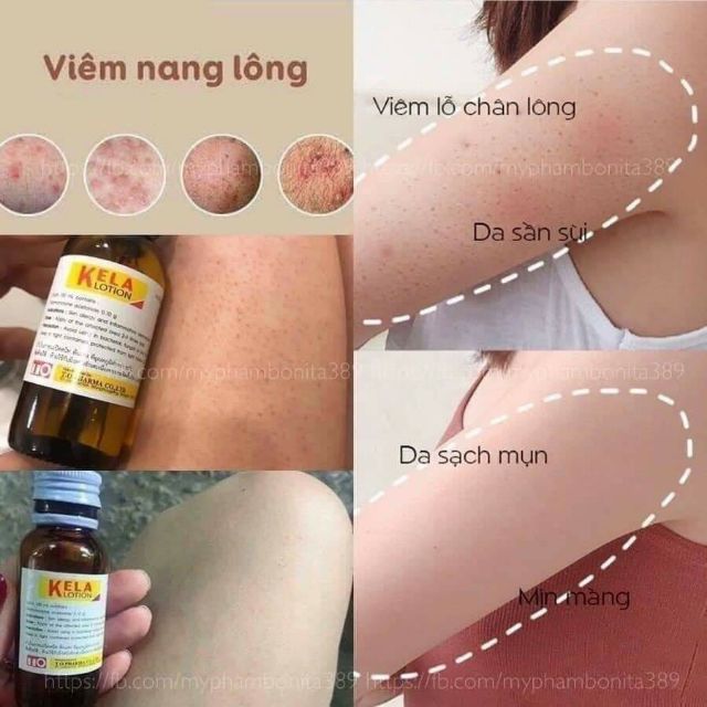 KELA LOTION bôi viêm nang lông Thái Lan