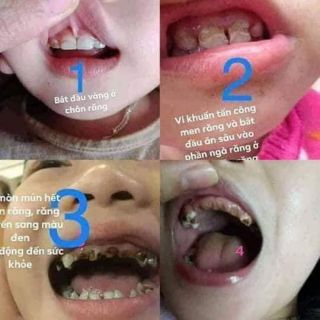 Tinh dầu sâu răng, hôi miệng Dạ Thảo Liên