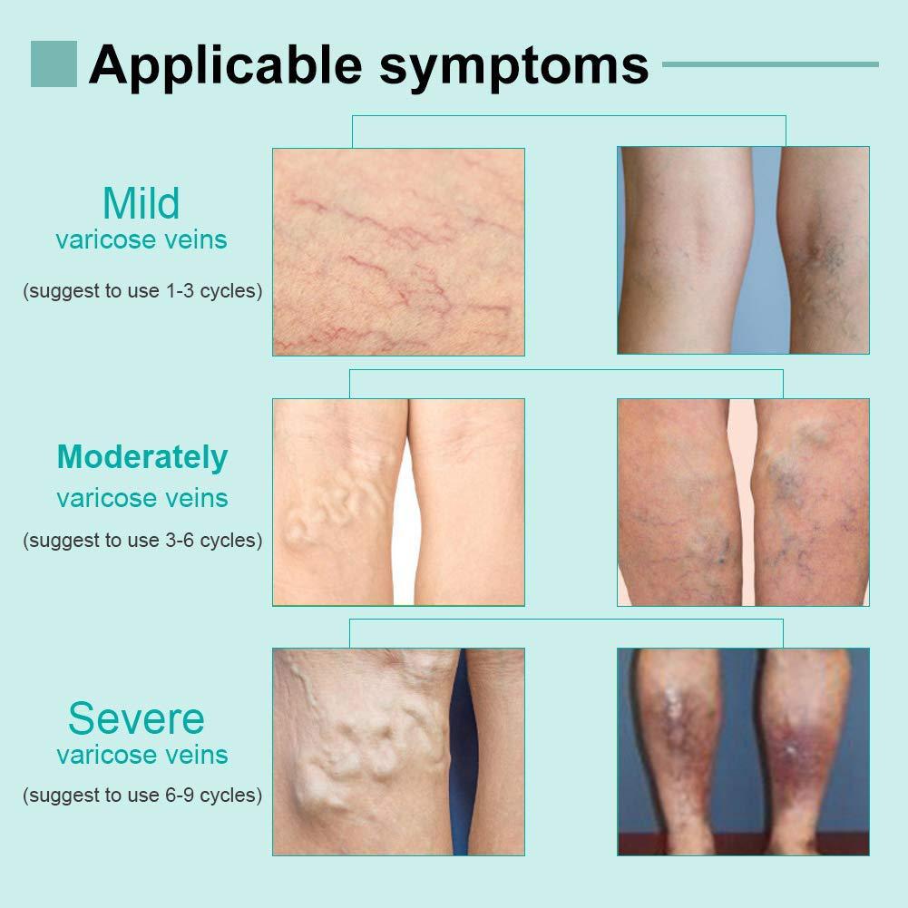 Kem giãn tĩnh mạch VOVA , sửa chữa các mao mạch, VOVA varicose veins cream 30ml