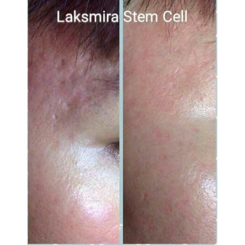 [Chính Hãng] Tế Bào Gốc RHA LAKSMIRA STEM CELL SOLUTION