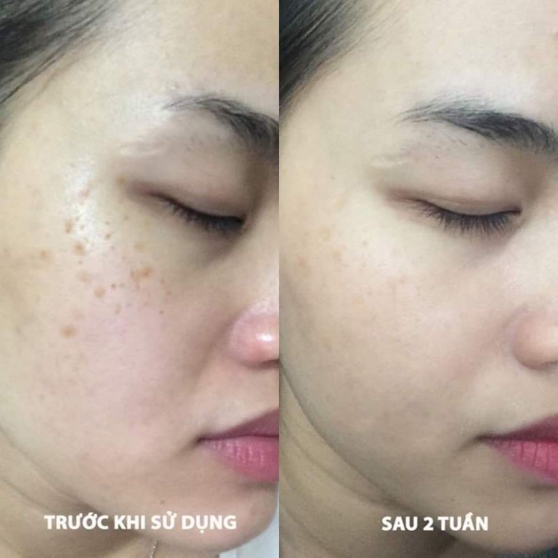 Kem Nám MelloDerm-HQ 4% Thái Lan Cho Da Nám, Tàn Nhang, Đồi Mồi