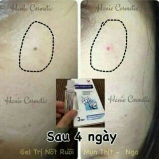 Gel Dvelinil tẩy nốt ruồi, mụn cóc, mụn thịt, sẹo lồi ( Chính hãng )