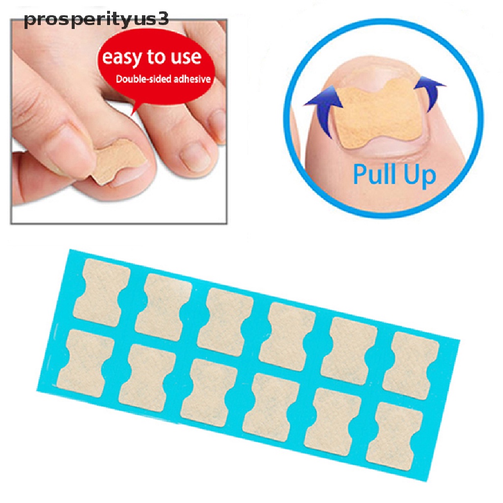 [prosperityus3] Ingrown Toenail Correction Tool Toe Nail Treatment Elastic Patch Sticker Clip [new]