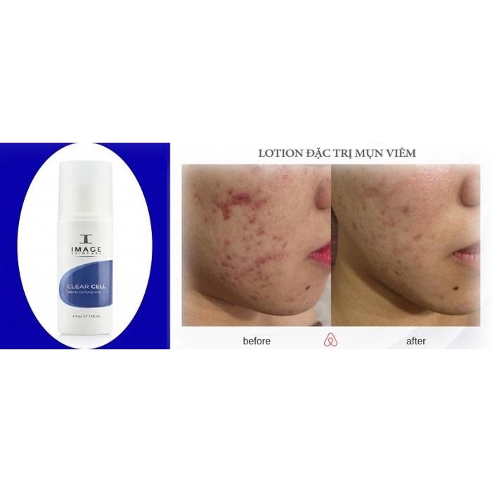 Lotion giảm mụn, giảm nhờn IMAGE CLEAR CELL MEDICATED ACNE LOTION