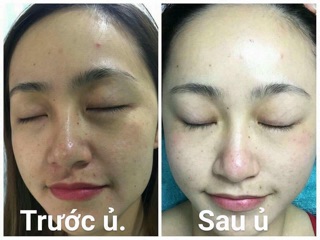 Ủ trắng mặt huyết yến
