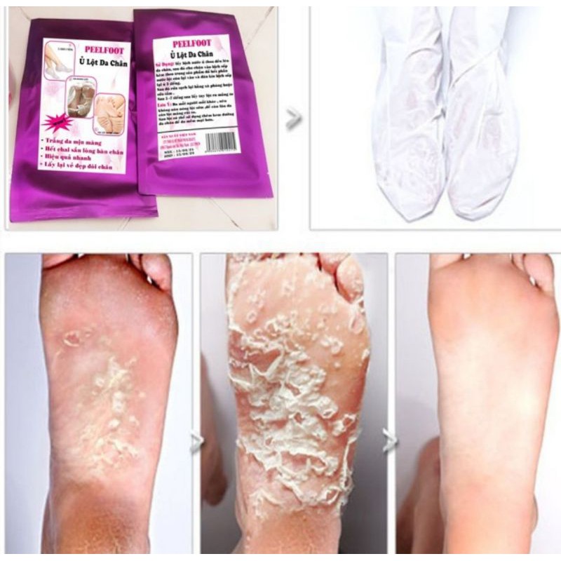 Ủ Lột Da Chân Trắng Mịn Hết Chai Sần đen nhám | BigBuy360 - bigbuy360.vn
