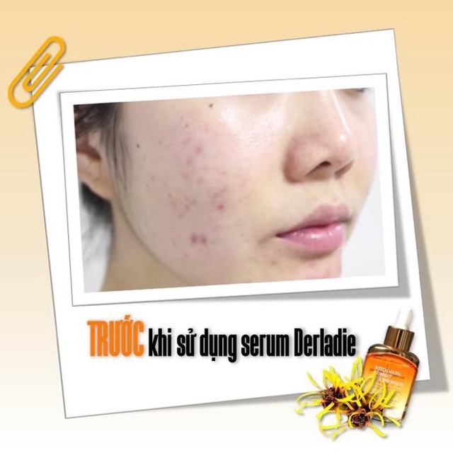 Tinh Chất Chiết Xuất Cây Phỉ Derladie Witch Hazel Perfect Vitamin Serum