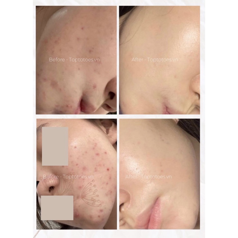 Serum Teana Anti-redness &amp; No Problem 10ml cho da mụn