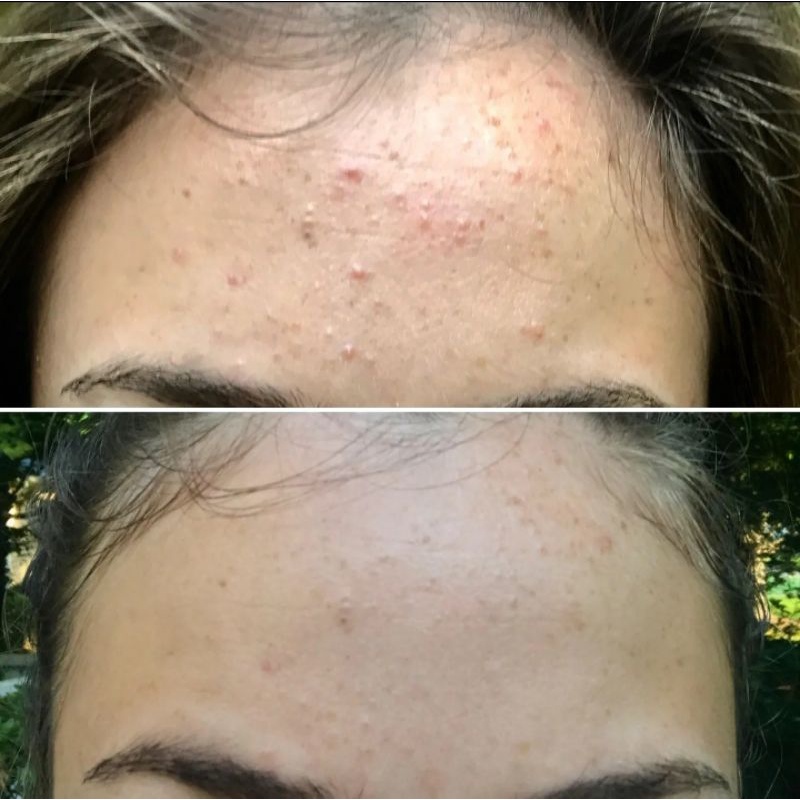 Pad Lau Stridex Body & Face BHA 0.5 - 2%