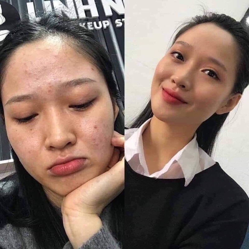 Serum Mộc Beauty Cho Da Mụn Thâm