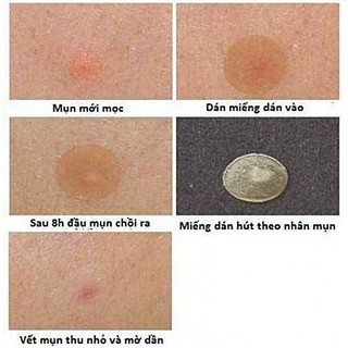 MIẾNG DÁN CHO DA MỤN COSRX ACNE PIMPLE MASTER PACTCH