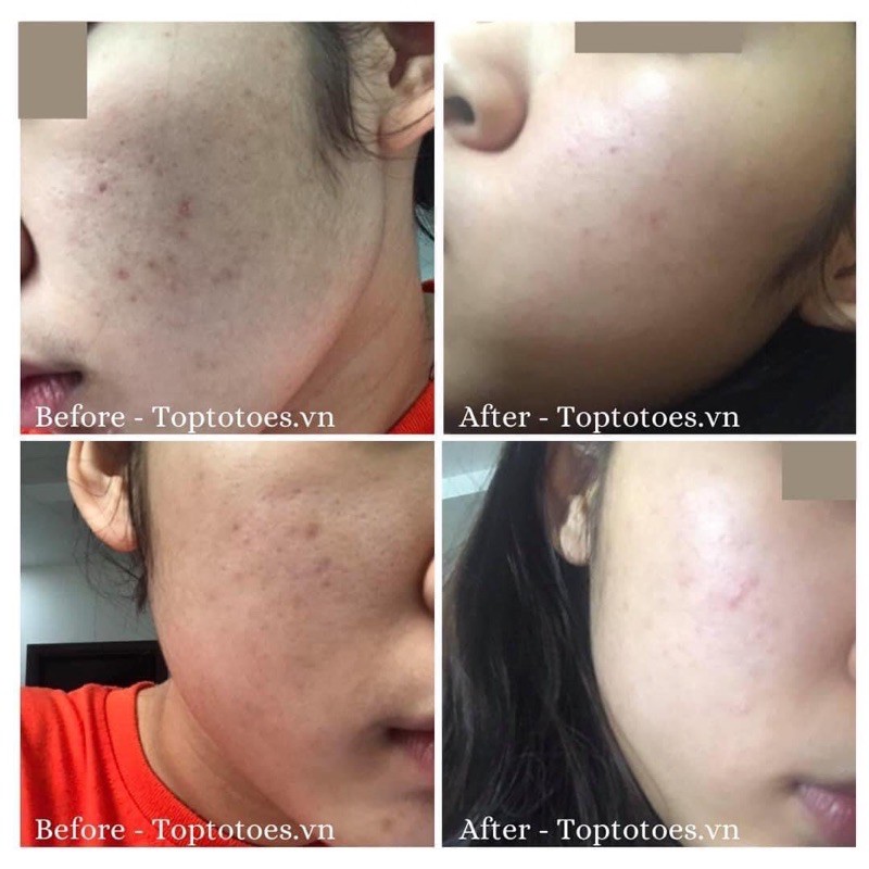 Serum Teana Super Peptides No Problem Intensive Care giảm sưng, đẩy & gom cồi mụn giảm tiết dầu