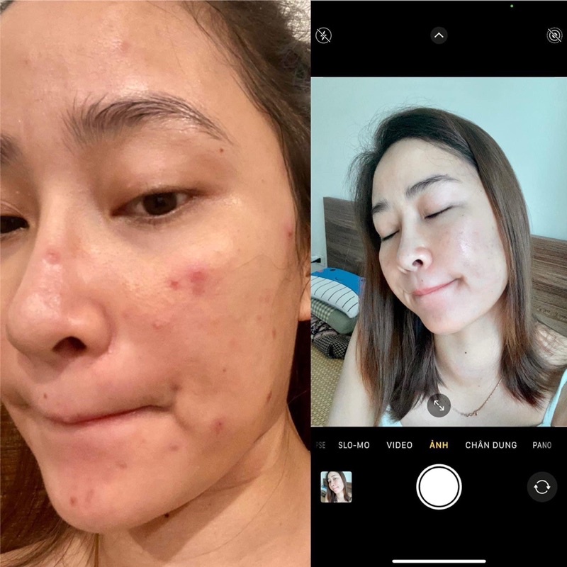 ✅ Neostrata Peel Tái Tạo Da, Giảm Nếp Nhăn Ngăn Ngừa Lão Hóa Prosystem Retinol Peel 1.5ml