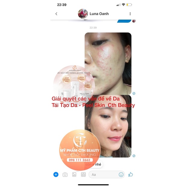 Bộ PeelSkin CthBeauty Tái Tạo Phục Hồi Da Mụn Sần Lỗ Chân Lông To Dầu Nhờn Nhạy Cảm, Tinh Chất Serum Detox Mụn