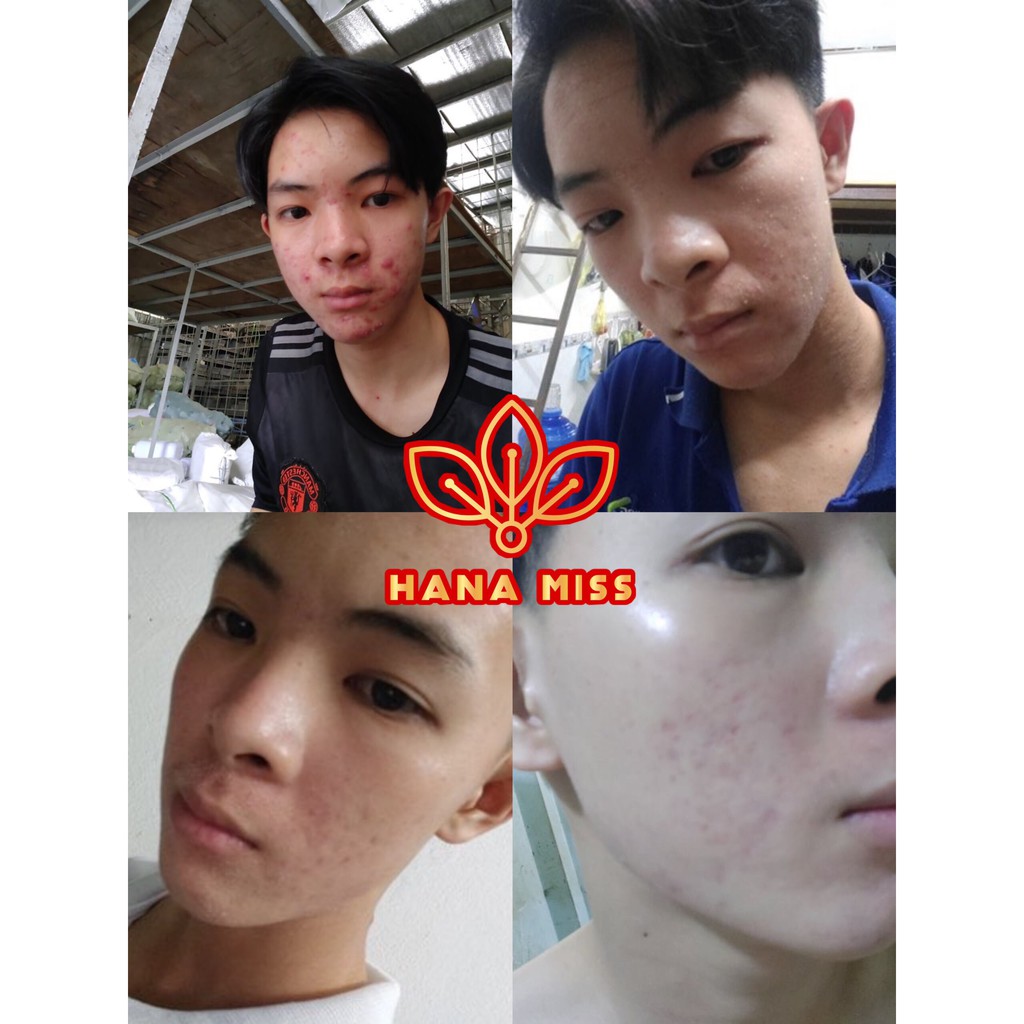 [DEAL SỐC] Serum xoá mụn giảm mụn - HANA MISS 🚫CAM KẾT KHÔNG HẾT MỤN HOÀN TIỀN🚫 | BigBuy360 - bigbuy360.vn