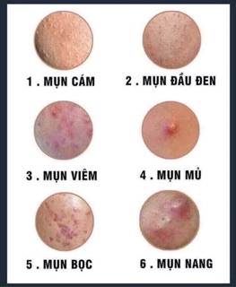 Bộ kem và serum trị mụn Lagivado