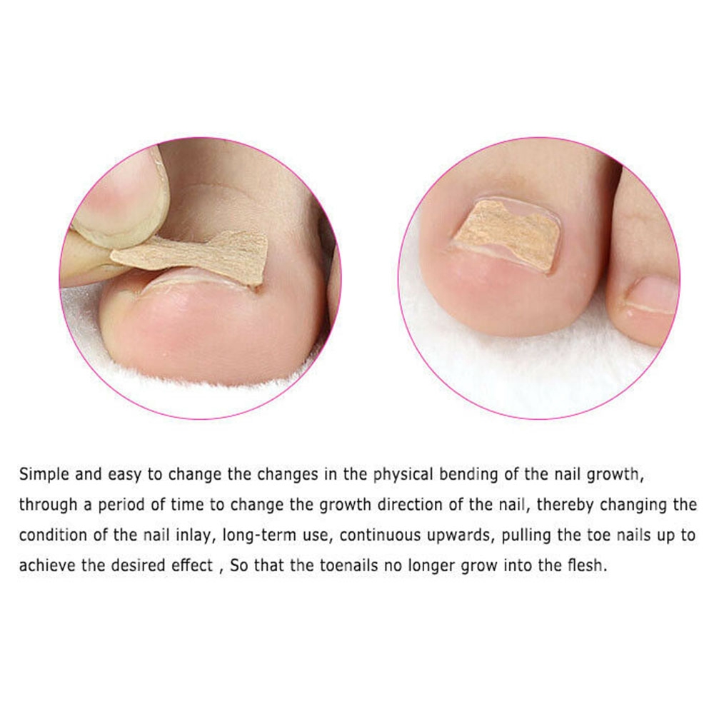 10PCS Non-Glue Toenail Patch Ingrown Toenail Correction Pedicure Tool