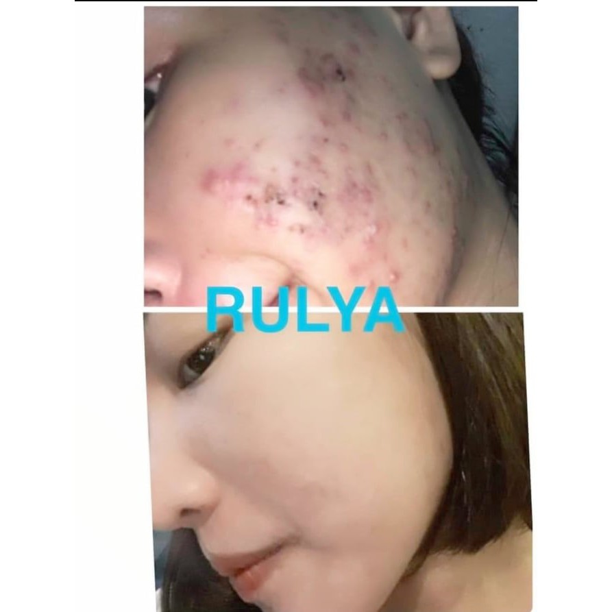 Serum Trị Mụn Rulya Silk Anti Acne