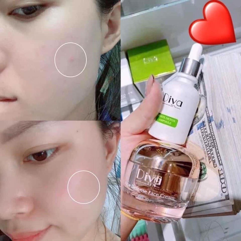 Kem Face MỤN cao cấp DIVA LYN Hàn Quốc | BigBuy360 - bigbuy360.vn