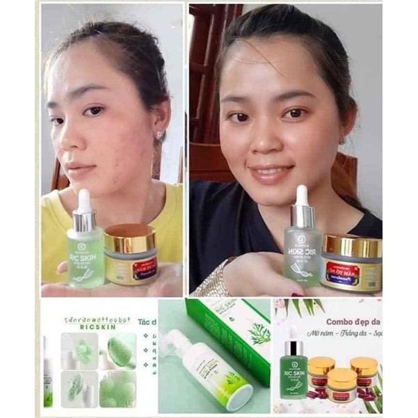 [CHÍNH HÃNG]Combo Serum Ric Skin + Sữa rửa mặt KOHINOOR