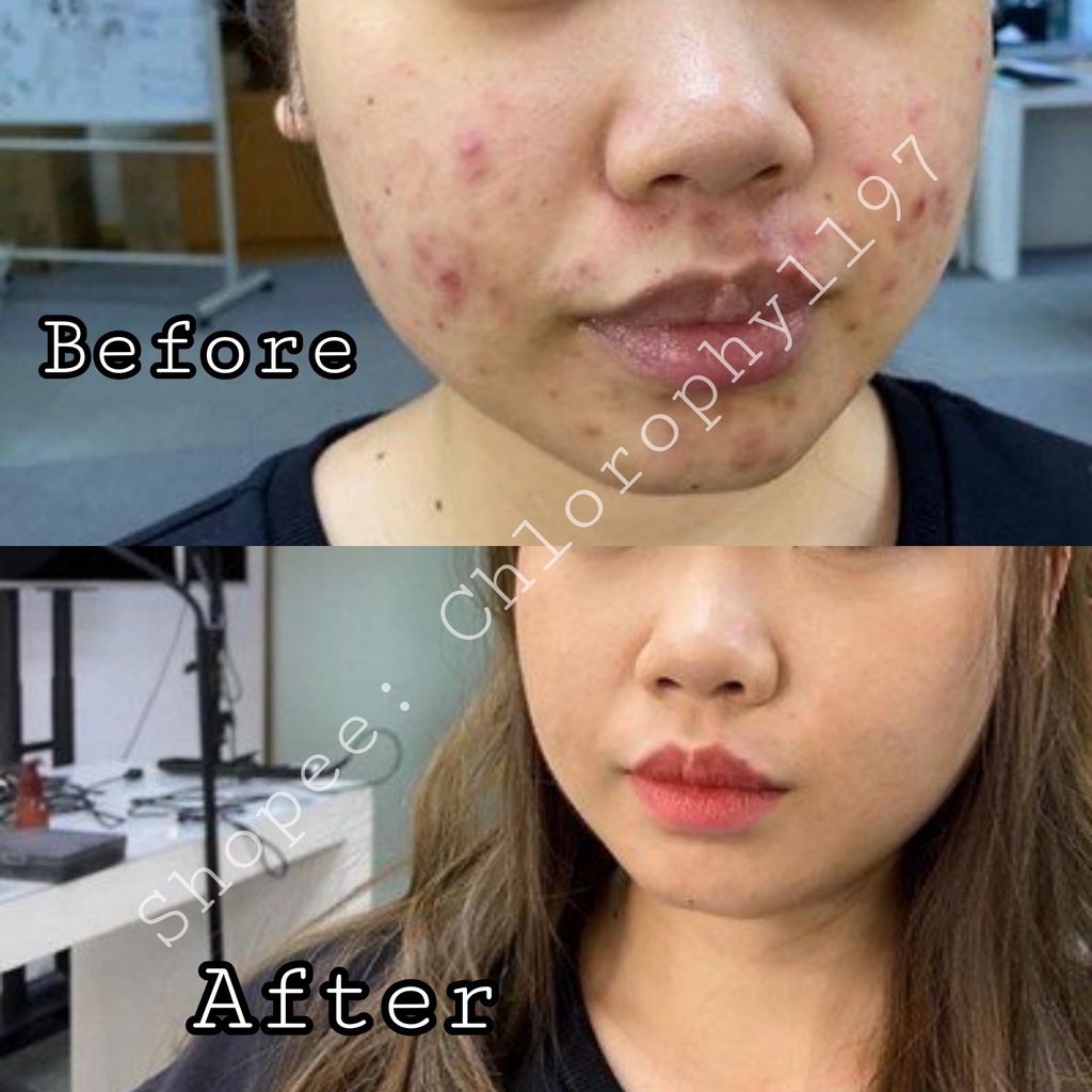 Kem giảm mụn, dưỡng sáng, mờ thâm, tẩy tế bào chết dịu nhẹ Azelaic Acid 15% Gel 10gr Gorgeous Beauty