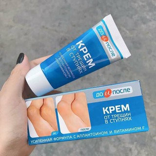 Kem trị nứt gót chân KPEM