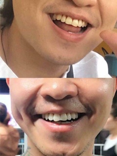 KEM ĐÁNH RĂNG CHO NGƯỜI HÚT THUỐC